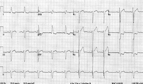 lvh litfl criteria.